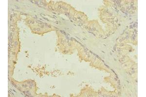 Immunohistochemistry of paraffin-embedded human prostate cancer using ABIN7164401 at dilution of 1:100 (SLC7A14 抗体  (AA 676-771))
