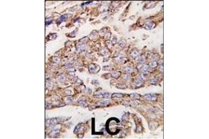 Formalin-fixed and paraffin-embedded human lung carcinoma tissue reacted with *LP1 antibody (N-term) (ABIN388566 and ABIN2849737) , which was peroxidase-conjugated to the secondary antibody, followed by DAB staining. (LAMP1 抗体  (N-Term))