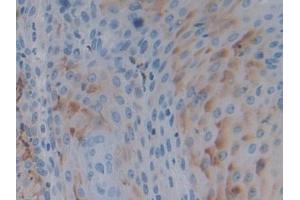 Detection of PTPRH in Human Skin cancer Tissue using Polyclonal Antibody to Protein Tyrosine Phosphatase Receptor Type H (PTPRH) (PTPRH 抗体  (AA 844-1096))