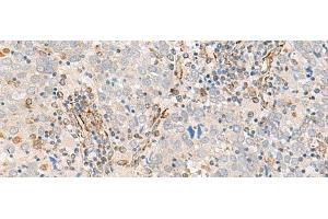 Immunohistochemistry of paraffin-embedded Human cervical cancer tissue using FECH Polyclonal Antibody at dilution of 1:55(x200) (FECH 抗体)