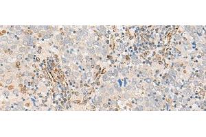 Immunohistochemistry of paraffin-embedded Human cervical cancer tissue using FECH Polyclonal Antibody at dilution of 1:55(x200) (FECH 抗体)