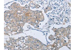 The image on the left is immunohistochemistry of paraffin-embedded Human breast cancer tissue using ABIN7189583(ABCB9 Antibody) at dilution 1/15, on the right is treated with synthetic peptide. (ABCB9 抗体)