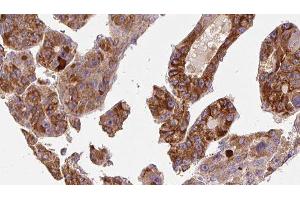 ABIN6277215 at 1/100 staining Human liver cancer tissue by IHC-P. (P2RY6 抗体  (C-Term))