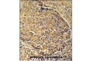 IGSF1 antibody (C-term) (ABIN654689 and ABIN2844381) immunohistochemistry analysis in formalin fixed and paraffin embedded human prostate carcinoma followed by peroxidase conjugation of the secondary antibody and DAB staining. (IGSF1 抗体  (C-Term))