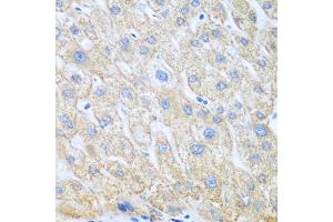 Immunohistochemistry of paraffin-embedded human liver cancer using COX1/COX1/PTGS1 antibody (ABIN6130124, ABIN6146413, ABIN6146414 and ABIN6223187) at dilution of 1:100 (40x lens). (PTGS1 抗体  (AA 1-180))