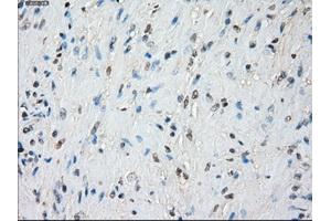 Immunohistochemical staining of paraffin-embedded Adenocarcinoma of colon tissue using anti-BUB1Bmouse monoclonal antibody. (BUB1B 抗体)