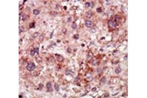 IHC analysis of FFPE human hepatocarcinoma stained with the GAK antibody (GAK 抗体  (AA 15-45))