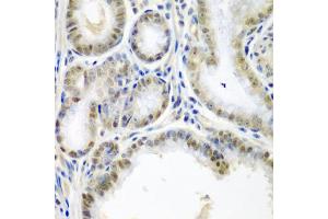 Immunohistochemistry of paraffin-embedded human colon carcinoma using SSX2 antibody (ABIN5974203) at dilution of 1/200 (40x lens). (SSX2 抗体)