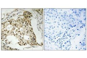 Immunohistochemistry analysis of paraffin-embedded human breast carcinoma tissue using Retinoic Acid Receptor α (Phospho-Ser77) antibody. (Retinoic Acid Receptor alpha 抗体  (pSer77))