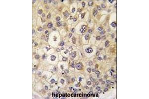 Formalin-fixed and paraffin-embedded human hepatocarcinoma tissue reacted with ARHE antibody (Center) (ABIN392162 and ABIN2841881) , which was peroxidase-conjugated to the secondary antibody, followed by DAB staining. (RND3 抗体  (AA 133-165))