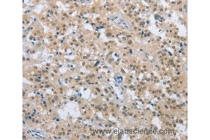 Immunohistochemistry of Human thyroid cancer using ENTPD5 Polyclonal Antibody at dilution of 1:20 (ENTPD5 抗体)