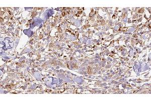 ABIN6276952 at 1/100 staining Human Melanoma tissue by IHC-P. (CNTF 抗体  (C-Term))