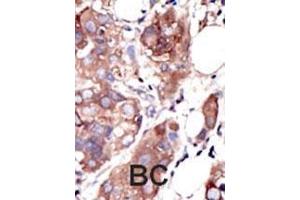 Formalin-fixed and paraffin-embedded human cancer tissue reacted with the primary antibody, which was peroxidase-conjugated to the secondary antibody, followed by AEC staining.