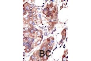 Formalin-fixed and paraffin-embedded human cancer tissue reacted with the primary antibody, which was peroxidase-conjugated to the secondary antibody, followed by AEC staining. (MUSK 抗体  (C-Term))