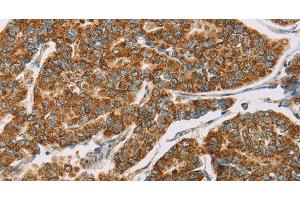 Immunohistochemistry of paraffin-embedded Human breast cancer tissue using DLL4 Polyclonal Antibody at dilution 1:40 (DLL4 抗体)