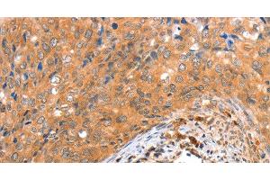 Immunohistochemistry of paraffin-embedded Human cervical cancer tissue using ACOX3 Polyclonal Antibody at dilution 1:35 (ACOX3 抗体)