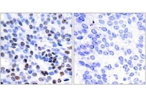 Immunohistochemistry analysis of paraffin-embedded human breast carcinoma tissue, using JunB (Ab-259) Antibody. (JunB 抗体  (AA 226-275))