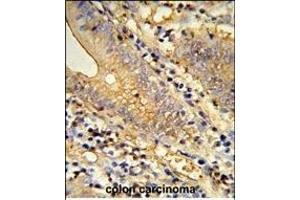 Formalin-fixed and raffin-embedded human colon carcinoma reacted with TSN33 Antibody (C-term), which was peroxidase-conjugated to the secondary antibody, followed by DAB staining. (TSPAN33 抗体  (C-Term))