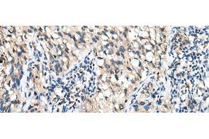 Immunohistochemistry of paraffin-embedded Human lung cancer tissue using DHRSX Polyclonal Antibody at dilution of 1:30(x200) (DHRSX 抗体)