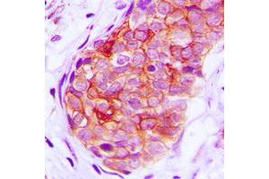 Immunohistochemical analysis of GRK6 staining in human breast cancer formalin fixed paraffin embedded tissue section. (GRK6 抗体  (N-Term))