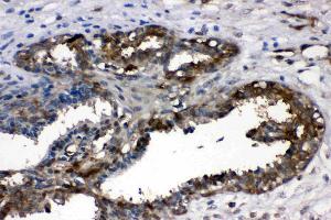 LDHA was detected in paraffin-embedded sections of human mammary cancer tissues using rabbit anti- LDHA Antigen Affinity purified polyclonal antibody (Catalog # ) at 1 µg/mL. (Lactate Dehydrogenase A 抗体  (AA 2-106))