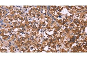 Immunohistochemistry of paraffin-embedded Human thyroid cancer tissue using FBXW7 Polyclonal Antibody at dilution 1:40 (FBXW7 抗体)