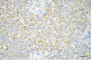 Immunohistochemistry was performed on paraffin-embedded human breast carcinoma using C1QBP antibody (ABIN7798136), 1:200). (Recombinant C1QBP 抗体)