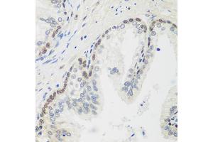 Immunohistochemistry of paraffin-embedded human prostate using MDC1 antibody (ABIN5974564) at dilution of 1/100 (40x lens). (MDC1 抗体)