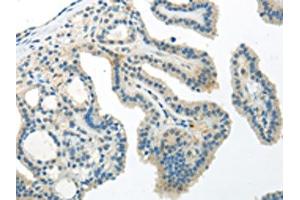 The image on the left is immunohistochemistry of paraffin-embedded Human thyroid cancer tissue using ABIN7193059(WNT10A Antibody) at dilution 1/30, on the right is treated with synthetic peptide. (Protein Wnt-1 (WNT1.L) 抗体)