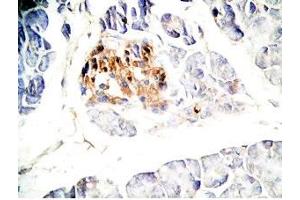 Human pancreas cancer tissue was stained by Rabbit Anti-GLP-1(7-36) -NH2 Antibody (GLP-1 抗体  (amidated))