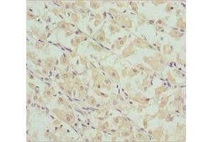 Immunohistochemistry of paraffin-embedded human gastric cancer using ABIN7149046 at dilution of 1:100 (CHIC2 抗体  (AA 1-165))
