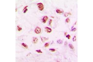 Immunohistochemical analysis of Histone Deacetylase 9 staining in human lung cancer formalin fixed paraffin embedded tissue section. (HDAC9 抗体  (C-Term))