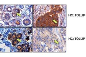 Middle panels, TOLLIP expression in matched normal and tumor breast samples. (TOLLIP 抗体  (C-Term))