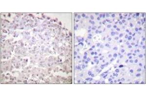 Immunohistochemistry analysis of paraffin-embedded human breast carcinoma tissue, using GADD153 Antibody. (DDIT3 抗体  (AA 91-140))
