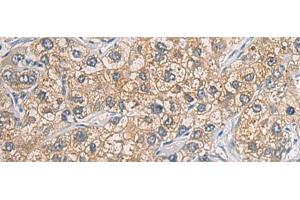 Immunohistochemistry of paraffin-embedded Human liver cancer tissue using GAB4 Polyclonal Antibody at dilution of 1:60(x200) (GAB4 抗体)