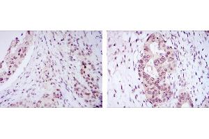 Immunohistochemical analysis of paraffin-embedded mammary cancer tissues (left) and ovarian cancer tissues (right) using NACC1 mouse mAb with DAB staining. (NAC1 抗体)
