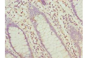 Immunohistochemistry of paraffin-embedded human colon cancer using ABIN7155961 at dilution of 1:100 (HABP2 抗体  (AA 314-560))