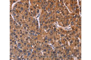 Immunohistochemistry of Human colon cancer using NFATC3 Polyclonal Antibody at dilution of 1:60