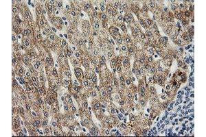 Immunohistochemical staining of paraffin-embedded Human liver tissue using anti-SOCS3 mouse monoclonal antibody. (SOCS3 抗体)