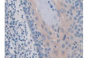 Detection of IREB2 in Human Skin cancer Tissue using Polyclonal Antibody to Iron Responsive Element Binding Protein 2 (IREB2) (IREB2 抗体  (AA 39-281))