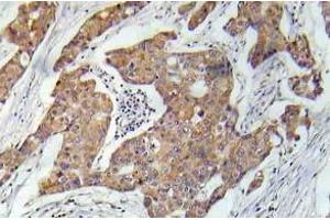 Immunohistochemistry (IHC) analyzes of VEGFR2 pAb in paraffin-embedded human prostate carcinoma tissue. (VEGFR2/CD309 抗体)