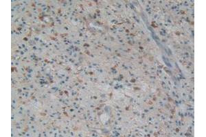 IHC-P analysis of Human Prostate Gland Cancer Tissue, with DAB staining. (Gelsolin 抗体  (AA 577-771))