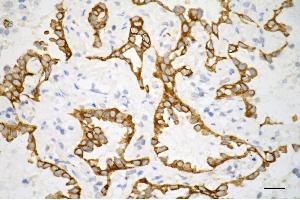 Immunohistochemistry was performed on paraffin-embedded human lung adenocarcinoma using keratin 7 antibody (ABIN7799186), 1:200). (Recombinant Cytokeratin 7 抗体)