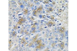 Immunohistochemistry of paraffin-embedded Human liver cancer using SERPINA1 Polyclonal Antibody at dilution of 1:100 (40x lens). (SERPINA1 抗体)