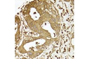 Immunohistochemistry of paraffin-embedded human liver cancer using ACTR2 antibody. (ACTR2 抗体  (AA 1-160))