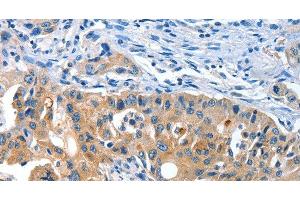 Immunohistochemistry of paraffin-embedded Human lung cancer tissue using AMHR2 Polyclonal Antibody at dilution 1:40
