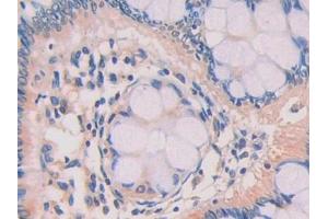 DAB staining on IHC-P; Samples: Human Colorectal cancer Tissue (ZBP1 抗体  (AA 10-167))