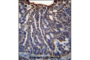 HOXB3 Antibody (Center) (ABIN656507 and ABIN2845779) immunohistochemistry analysis in formalin fixed and paraffin embedded human ovarian carcinoma followed by peroxidase conjugation of the secondary antibody and DAB staining. (HOXB3 抗体  (AA 119-148))