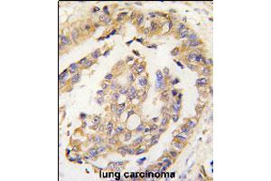 Formalin-fixed and paraffin-embedded human lung carcinoma tissue reacted with OLFM1 polyclonal antibody  , which was peroxidase-conjugated to the secondary antibody, followed by DAB staining. (Olfactomedin 1 抗体  (N-Term))