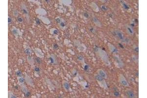 Detection of GAP43 in Human Glioma Tissue using Polyclonal Antibody to Growth Associated Protein 43 (GAP43) (GAP43 抗体  (AA 1-274))